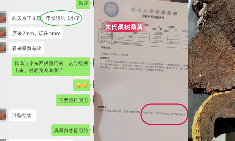 甲狀腺結節吃桑樹桑黃案例